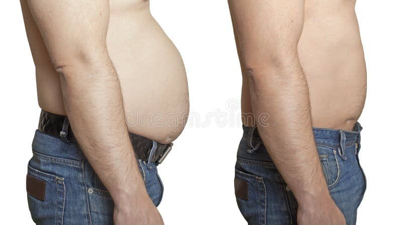Study finds tummy-tuck patients still losing weight five years after