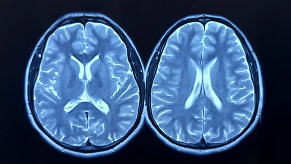 Covid-19 pandemic aged your brain faster even if you never got sick – Study