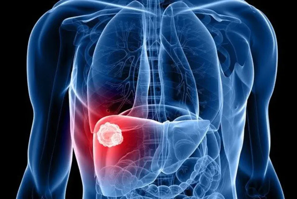 Liver cancer to double worldwide, most of it preventable – Study