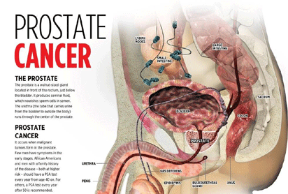 Prostate cancer: 5 early symptoms men shouldn’t ignore