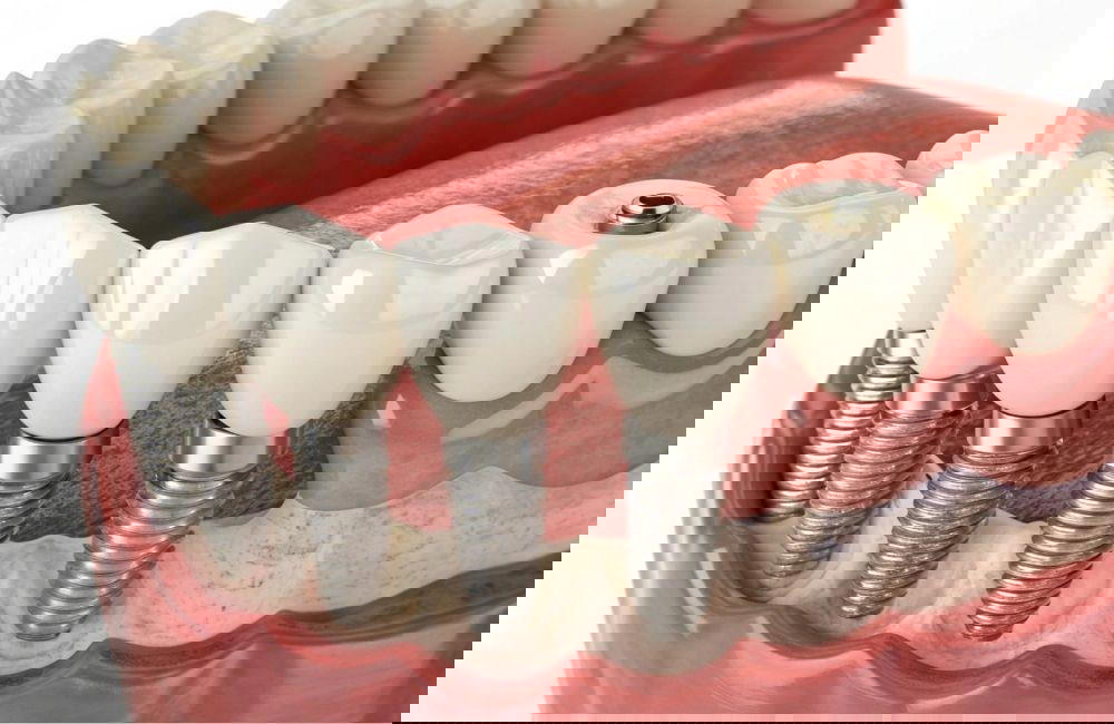 Why Turkey is becoming the global hub for affordable, high-quality dental implants